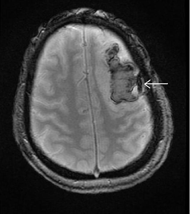 Idbaih A et al Stroke 2006 MRI: T2*SW
