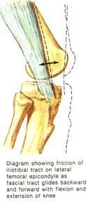 WHY DOES IT HURT? As the knee bends, tension acting on the band, causes it to be pulled backwards over the lateral femoral epicondyle, (a bony prominence of the thigh bone on the outside of the knee).
