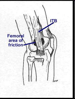 ITB Syndrome: Definition ITB Syndrome is an overuse condition of the distal ITB near the lateral femoral condyle and at Gerdy s tubercle.