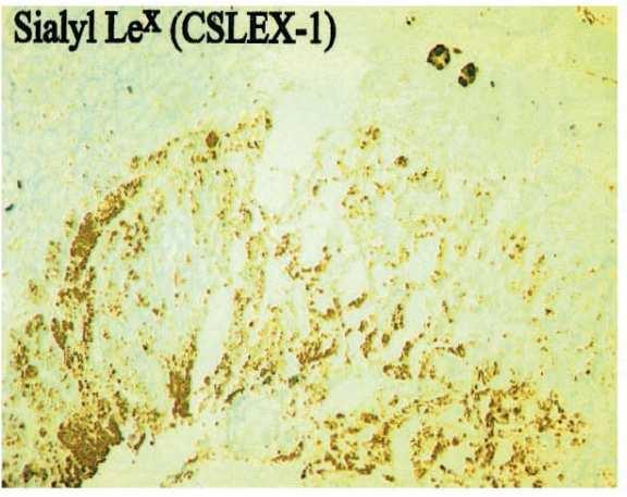 SIALYL LEWIS-X ANTIGEN IS OVEREXPRESSED IN COLON CANCER From: Izawa et al.