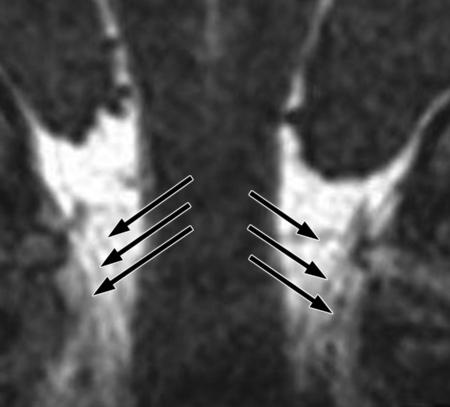 8-mm-thick SSFP MR image shows the spinal rootlets (arrows) of the accessory nerve arising from the upper spinal cord to cross the foramen magnum and join the cranial rootlets.