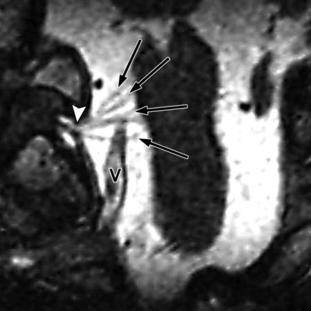 The cranial rootlets emerge into the lateral cerebellomedullary cistern below the vagus nerve (Fig 19). The spinal root- Figure 21. Coronal oblique 0.