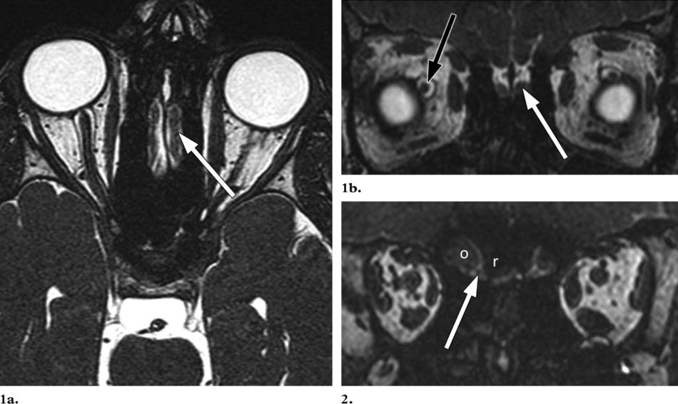 1046 July-August 2009 radiographics.rsnajnls.org Figures 1, 2. Olfactory nerve. (1) Axial (a) and coronal (b) 0.