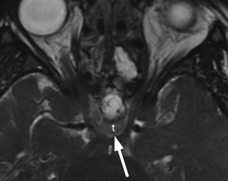 1048 July-August 2009 radiographics.rsnajnls.org Figure 5. Residual tumor near the optic chiasm in an 18-year-old woman after resection of a pituitary adenoma. Axial oblique 0.