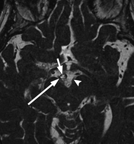 8-mm-thick SSFP MR image shows the oculomotor nerve (white arrow) in cross section between the posterior cerebral artery (white arrowhead) and the superior cerebellar artery (black arrowhead),