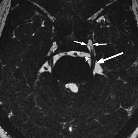 1050 July-August 2009 radiographics.rsnajnls.org Figure 10. Trigeminal nerve. Axial 0.
