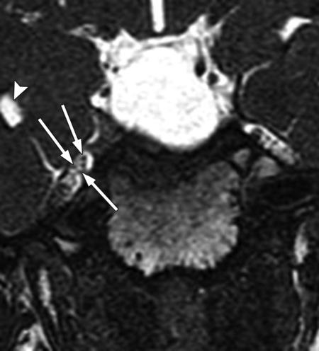 enter the Meckel cave (small arrows). Figure 11. Trigeminal nerve. Coronal 0.