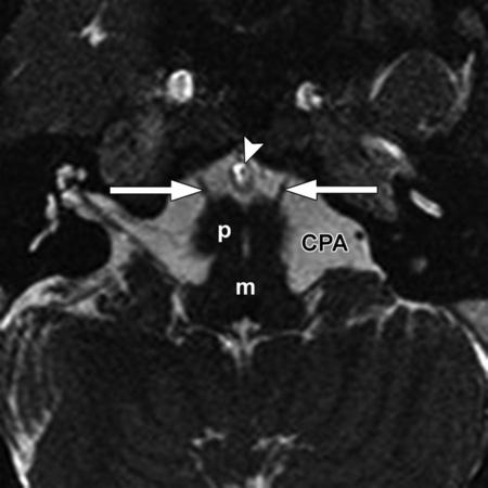 the gasserian ganglion. The temporal horn of the lateral ventricle (arrowhead) is also shown. Figure 12. Abducens nerve. Axial 0.