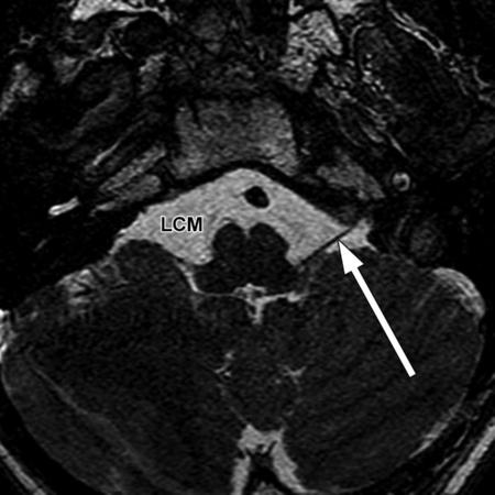 The two roots of the vagus nerve (arrowheads) are visible in the same plane, and the superior and inferior vestibular nerves can be seen above the flocculus. Figure 18. Axial oblique 0.