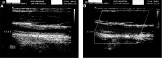 Ultrasound B-mode and color-duplex flow imaging of the left common carotid artery (longitudinal section): homogeneous, midechoic, circumferential wall thickening ("macaroni sign") with luminal