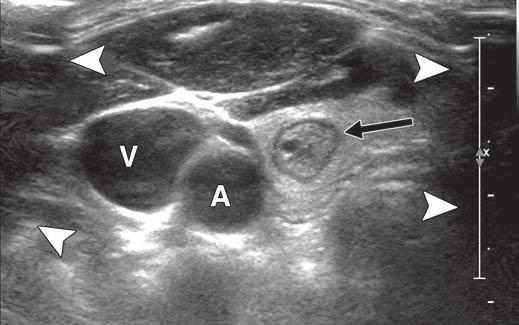 Ultrasound of Thyroid Masses however, no reports on manual compressibility of thyroid masses with an ultrasound probe have been published.