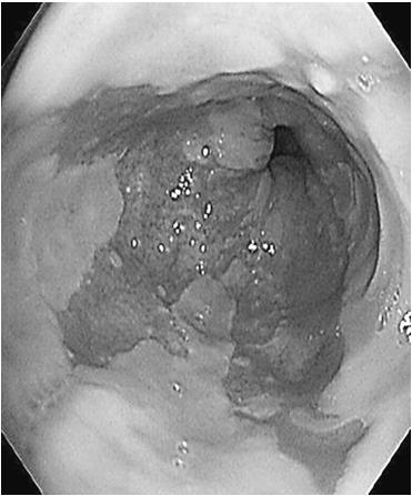 3/22/217 onclusions of cute GERD Study Reflux esophagitis healed by PPIs returns within 2 weeks of stopping PPIs.