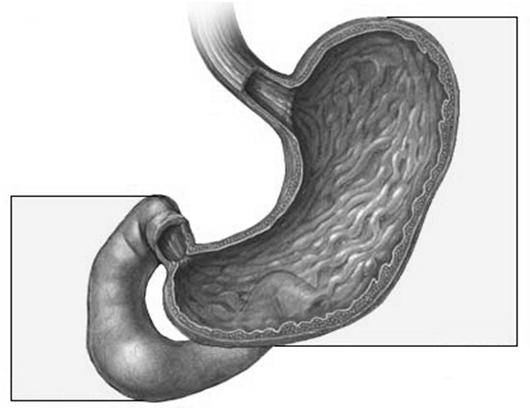 not denatured by gastric acid can reflux into the esophagus Meta-nalysis Studies on Risk of Developing High-Grade Dysplasia (HGD) or denocarcinoma (E) in arrett s Patients on PPIs PPI use associated