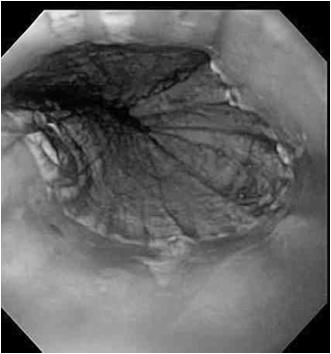 Surveillance for Low- Grade Dysplasia (LGD) in arrett s Esophagus 136 patients with LGD confirmed by expert