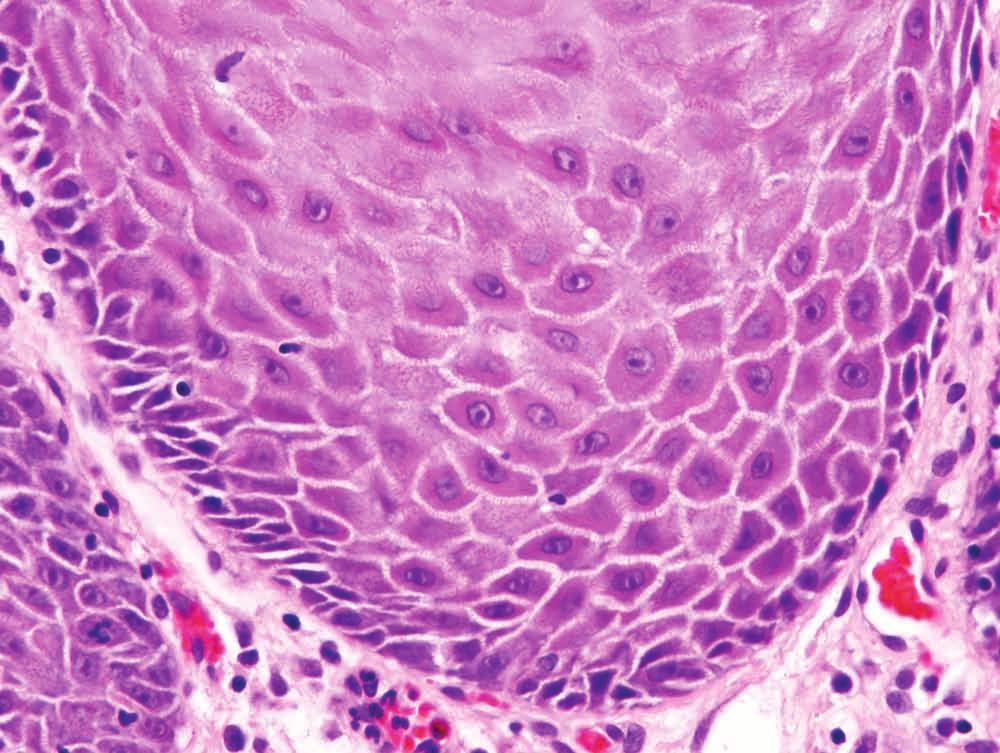 than the adjacent benign epithelium (left), diagnostic of