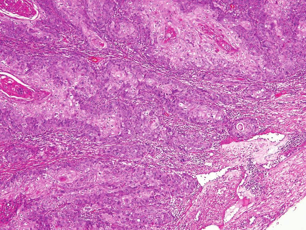 parakeratosis (surface is to the left). 5.4 (right).