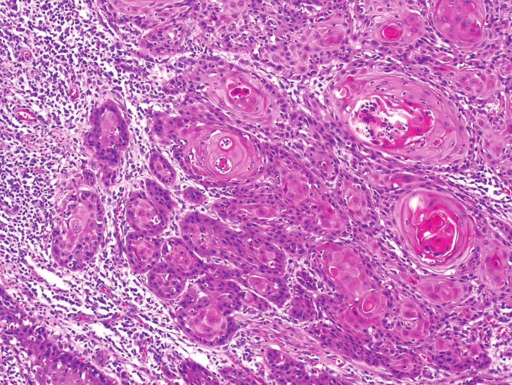 6 Squamous cell carcinoma, usual type with ragged nests of