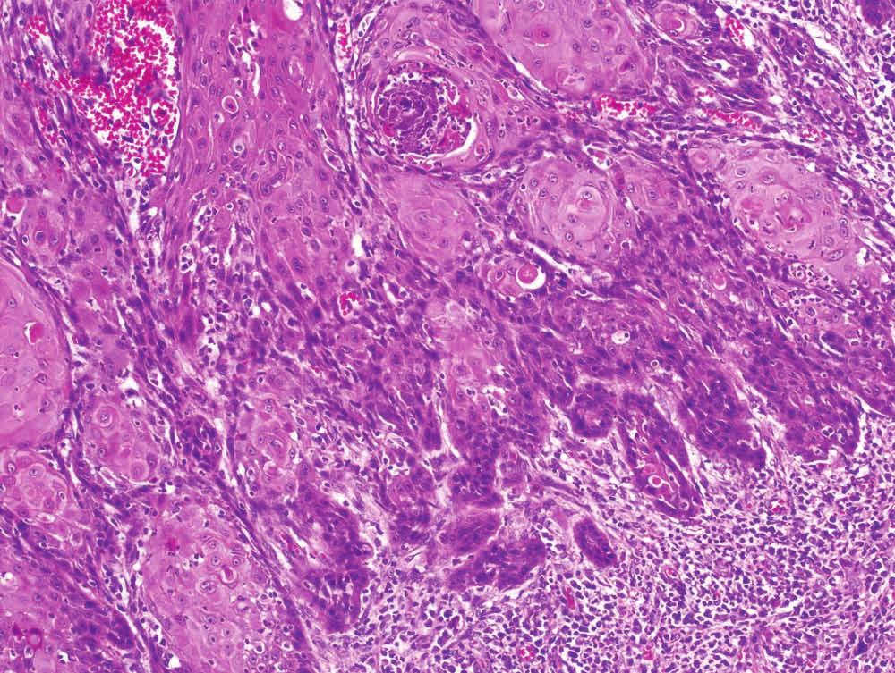 7 Squamous cell carcinoma, usual type with irregular small
