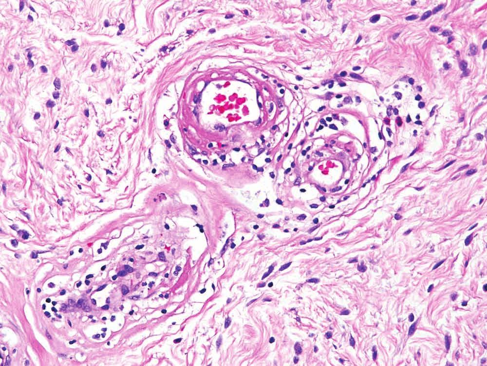Cellular angiofibroma with vessels showing fibrin Figure 5.8.