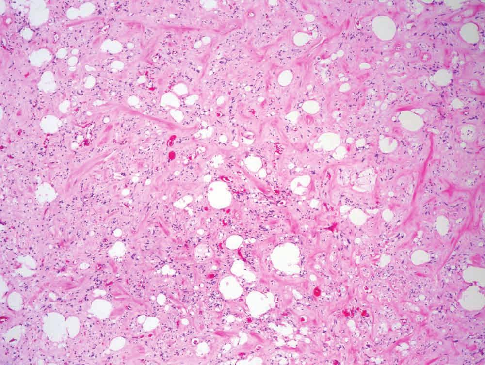 8 Well-differentiated liposarcoma showing areas of