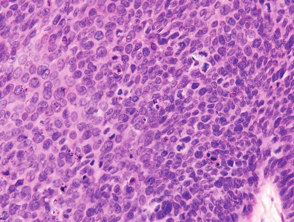 2 Same case as Figure with nest of cells with pale cytoplasm