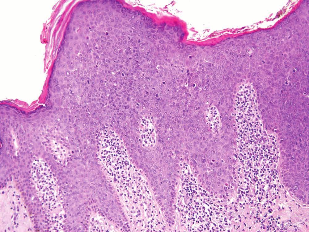 Invasive Paget disease is seen in the dermis (bottom). Figure 5.