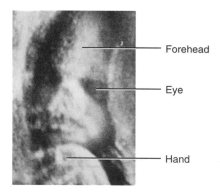 Image or sonogram is displayed on video monitor Used for fetal ultrasound and examination of pelvic & abdominal organs,