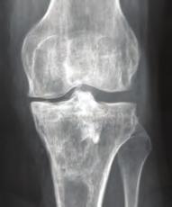 At two years, good healing was seen with no delimitation between bone and STRUCSURE CP material.