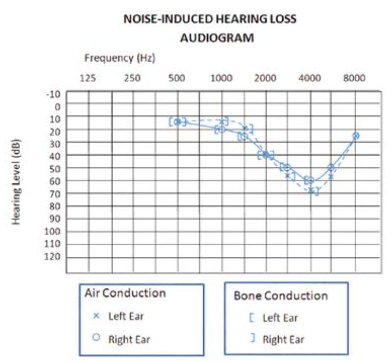 presbycusis, 10,15 in the general population make symmetrical SNHL the most common type of hearing loss.