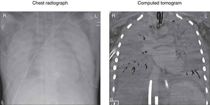 Chest Radiograph and Computed Tomogram of 2 Patients Successfully Treated With ECMO for Confirmed 2009 Influenza A(H1N1)