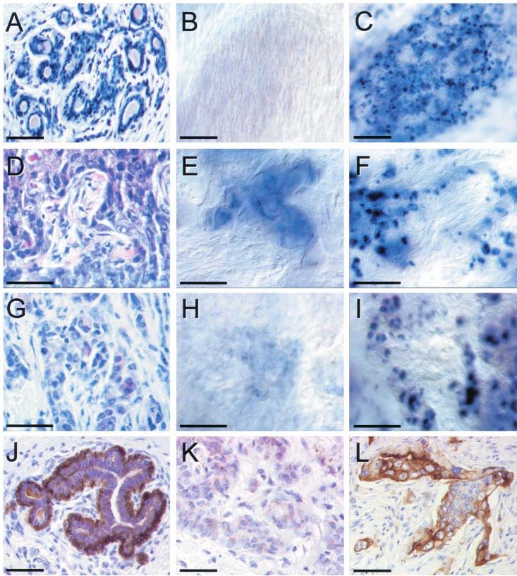 3243 Figure 1 In situ hybridization for Snail (b, e, h) and E-cadherin (c, f, i) and immunohistochemical (IHC) analyses for P-cadherin (j ± l) in normal breast tissue (a ± c, j) and invasive ductal