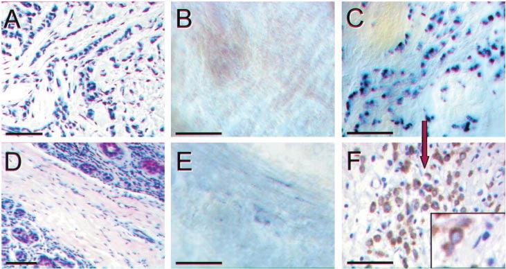 3244 Table 1 Pathological, in situ hybridization and immunohistochemical results of the complete series Case Type Grade LNM Snail E-CD E-CD (ISH) P-CD (IHC) b-catenin Plakoglobin ER PR 1 IDC 1 0 7 +