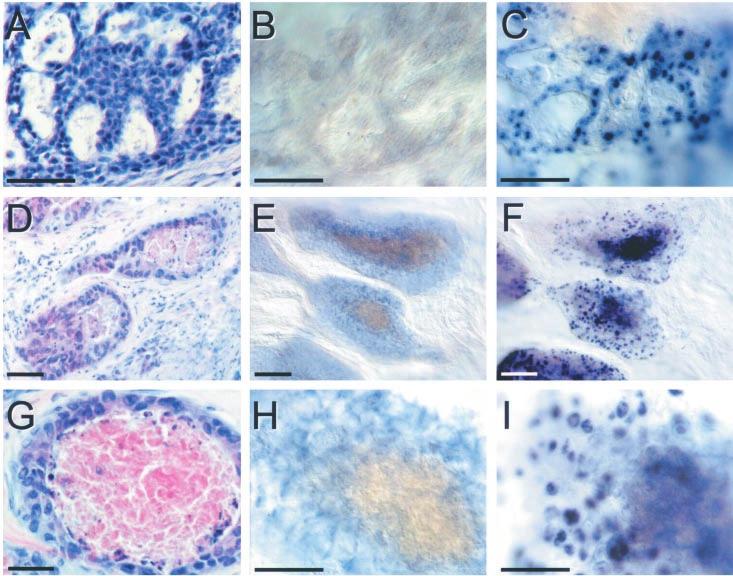 Table 2 Relationships between Snail expression and pathological and immunohistochemical features in in ltrating ductal carcinomas Snail-negative Snail-positive P Grade 1 4 (100%) 0 2 3 (43%) 4 (57%)