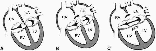 ATRIOVENTRICULAR SEPTAL DEFECT ANATOMY May be partial or complete