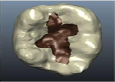 The teeth scanned were compared to find out: (a) how consistent was the manufacturing of the individual teeth; (b) how accurately the students prepared a cavity and removed the carious tissue and (c)