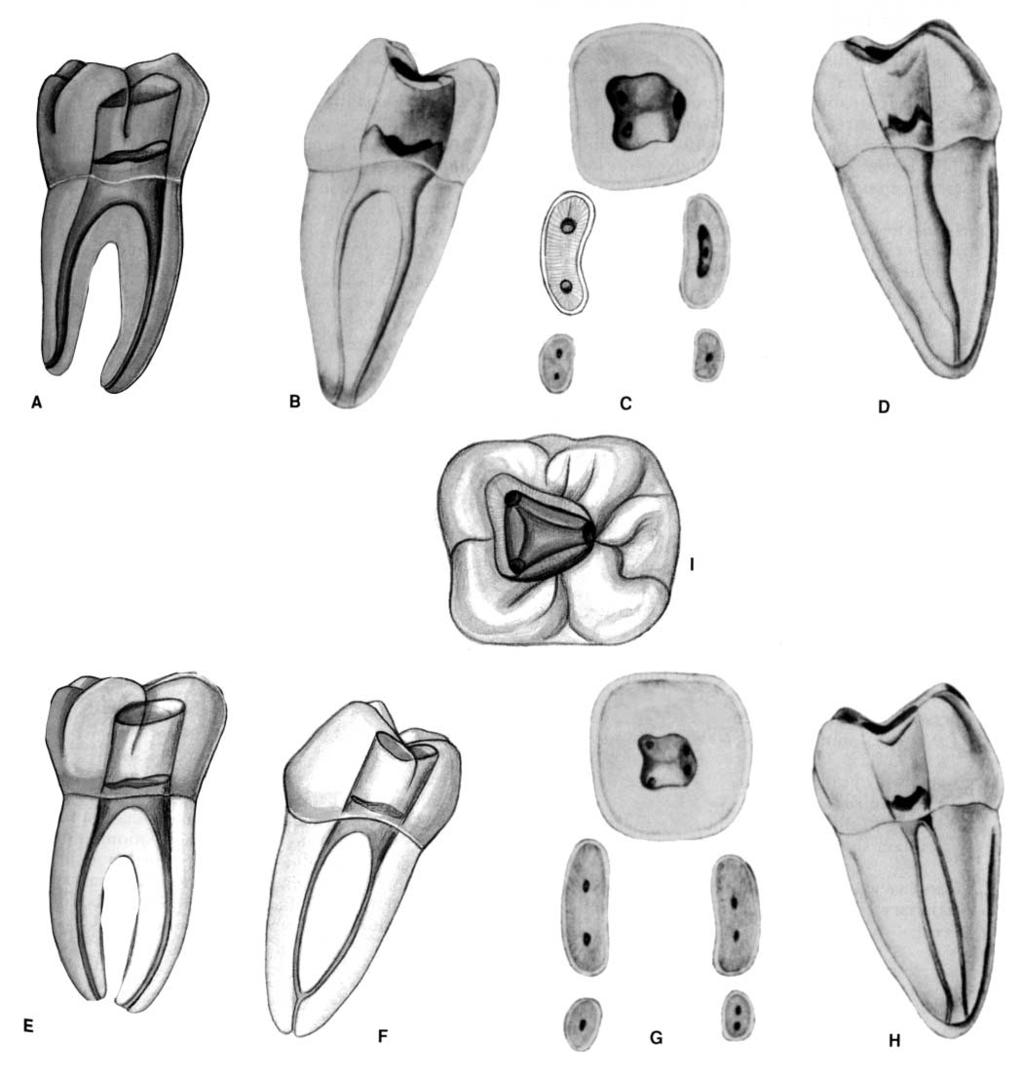 PLATE 25 Mandibular First Molars Canals Curvature of Roots Length of Tooth Mesial Distal Roots Canals Mesial Distal Direction Mesial Distal Average 20.9 mm 20.9 mm Two roots 97.8% Two canals 6.