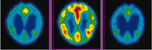 Mood Disorders- Bipolar PET scans show that brain energy consumption rises