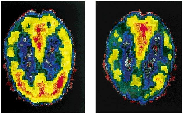 Personality Disorders PET scans illustrate reduced