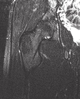 5-T system (Signa, GE Healthcare) and a torso phasedarray coil. T1-weighted spin-echo imaging was performed at a TR of 800 milliseconds and a minimum TE, typically 15 18 milliseconds.