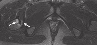 slightly proximal to its insertion and marrow edema extending to inferomedial femoral neck (dashed arrow, C).