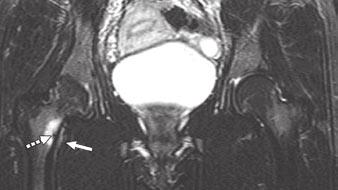femoral neck, and were visible on both T1- and T2-weighted images (Fig. 3G).