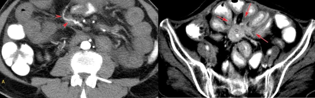 segmental, homogenous circumferential thickening of the small bowel with mild enhancement involving jejunal and ileal loops (arrows).