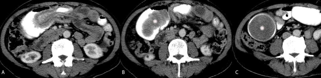 Also note bulky kidneys with smooth contour, changes related to paroxysmal nocturnal hemoglobinuria. Fig. 9: Carcinoid.
