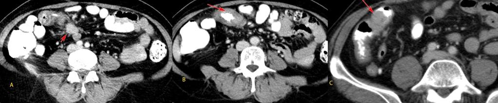 Fig. 11: Jejunal adenoma. 58 year old man presented with recurrent episodes of colicky abdominal pain and vomiting.
