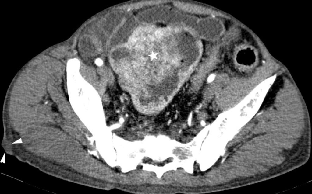 65 year old man with diarrhea and weight loss. Contrast -enhanced axial CT image shows intensely enhancing mesenteric mass with speculated margins (arrow head).
