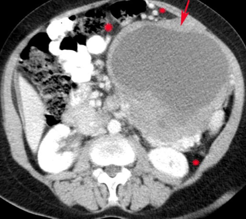 Contrast enhanced CT image shows well defined,