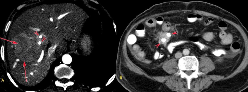 Fig. 16: GIST. 41 year old man with vague pain in abdomen.