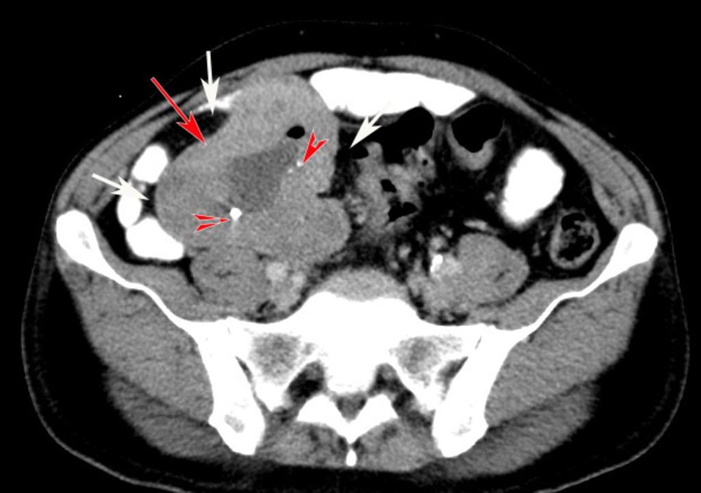 infiltration (asterisk). Fig. 17: Carcinoid.
