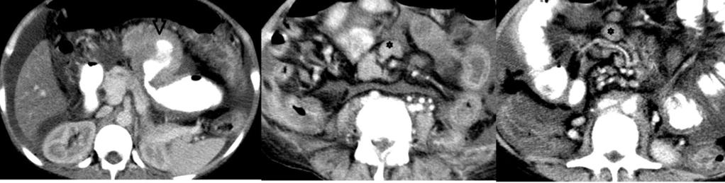 Fig. 18: GIST. 54 year old man with fever since 3months, on clinical examination suspected lower abdominal mass.