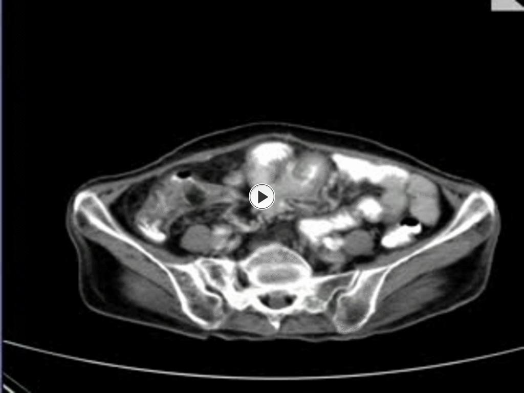 Fig. 10: Small bowel